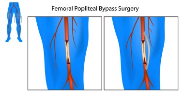 Femoral Popliteal Bypass Surgery. Leg Artery Bypass Surgery Diagram. Procedure for Leg Artery Blockage clipart