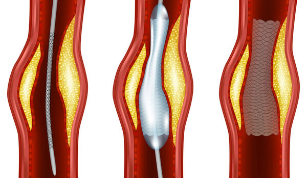Иллюстрация процедуры ангиопластики. Шариковая ангиопластика шаг за шагом. Диаграмма расположения стента артерии. Сужение артерии.