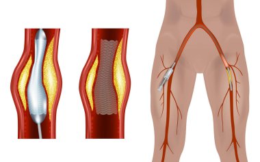 Femoral Endovasküler Prosedür. Uyluk atardamarları ve popliteal arterleri gösteren bir resim. Anjiyoplasti femoral arter.