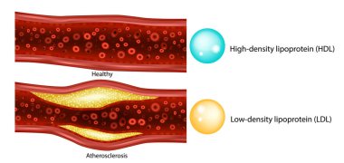 Kolesterol. Düşük yoğunluklu lipoprotein yüksek yoğunluklu lipoprotein. Ateroskleroz, atardamar plağı.