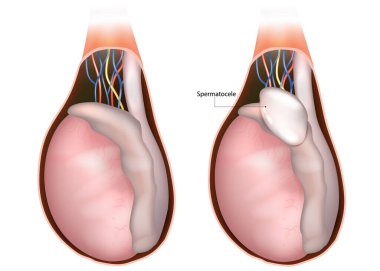 Spermatocele Tıbbi İllüzyon. Epididymis Diyagramında Spermatocele Kisti. Testis anatomisi. Erkek Üreme Sistemi Bozukluğu