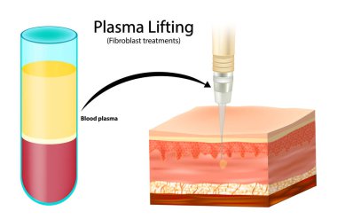 Plazma kaldırma ya da Fibroblast tedavisi. Yenilenme için kan plazma enjeksiyonu illüstrasyonu. Plazma Kaldırma Prosedürü PRP terapisinin Tıbbi Diyagramı