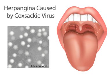 Coxsackievirus 'un sebep olduğu Herpangina. Boğaz ve Ağızdaki Coxsackievirüs enfeksiyonunun Tıbbi İllüstrasyonu. Coxsackie Virüsü 'nden Oral Herpangina Ülserleri