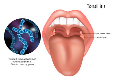 Detaylı tıbbi göstergeler bademcik iltihabı belirtilerini gösteriyor. Boğaz içindeki şişmiş kırmızı bademcikler ve beyaz noktalar da dahil. Görüntü ayrıca bakteriyel bademcik iltihabından sorumlu en yaygın bakteri olan Streptococcus pyogenes 'i de vurgular..