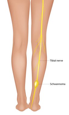 İnsan Bacağı Anatomisi 'nde Tibial Sinir Schwannoma İllüstrasyonu. Tibial Sinir Çevre Görsel Tümörünün Schwannoma Tıbbi Diyagramı