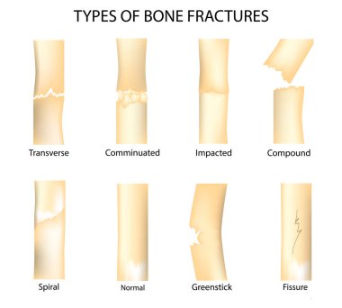 Anatomik tıbbi örnekleme, çapraz, parçalanmış, etkilenmiş, bileşik, spiral, yeşil çubuk ve çatlak gibi çeşitli kemik kırıkları gösteriyor..