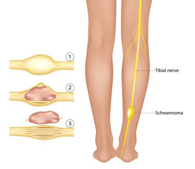 Tibial Sinir Tümörü Anatomisi. Periferik sinir kılıfı tümörü bacağında. Schwannoma Tıbbi Görselleştirme. İyi huylu bir tümörün tibiyal sinirden cerrahi müdahaleyle alındığını gösteren detaylı tıbbi çizimler..