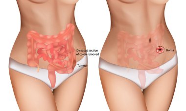Kolon Kanseri Cerrahisi ve Stoma Formasyon Tıbbi İllüzyonu. Kolostomi Diyagramı ile sindirim yolu tümörü temizleme. Renkli Tümör Rezeksiyonu ve Ostomi Prosedürü Anatomisi