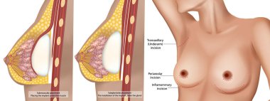Detaylı tıbbi illüstrasyon iki tip göğüs implantı olduğunu gösteriyor. Kas altı ve alt salgı bezleri. Transaxillary, periareolar ve inframammary de dahil olmak üzere göğüs büyütme ameliyatlarının yapılacağı yerler.