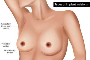 Göğüs implantı ensizyonu. Tıbbi İllüzyon. Göğüs Cerrahisi Kesme Seçenekleri Vektör Diyagramı. Estetik Cerrahi Göğüs İmplantı Erişim Noktaları Etiketlendi