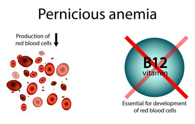 B12 vitamini eksikliği olan tehlikeli Anemi illüstrasyonu. Tıbbi Diyagram, B12 eksikliğinde azalan kırmızı kan hücrelerini gösteriyor. Zararlı Anemi ve B12 vitamini önemi bilgisiName