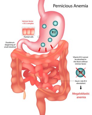 Eğitimsel tıbbi illüstrasyon zararlı anemi mekanizmasını gösteriyor. Diyagram, ileumda B12 vitamini emilimi için gerekli olan içsel faktör üreten midenin yan hücrelerini vurgular. Megaloblastik Anemia