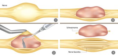 Schwannoma 'nın Peripheral Sinir' den cerrahi müdahaleyle alınması. Adım adım Schwannoma Kesiminin İllüstrasyonu. Sinir Tümörü Rezeksiyonunun Tıbbi Diyagramı