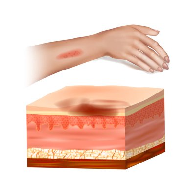 İnsan Kolunda Etkilenmiş Doku ile Deri Lezyonu Bölümü. Deri enfeksiyonu ve deri altı iltihabının tıbbi gösterimi