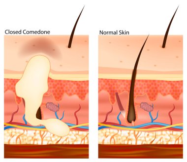 Kapalı Komedinin ve Normal Cildin Tıbbi İllüstrasyonu. Görüntü deri katmanlarını, saç köklerini, yağ bezlerini ve gözenek tıkanıklığını gösteriyor..