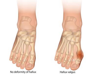 Hallux valgus deformasyonunun anatomik çizimi ya da Hallux deformasyonu yok. Hallux Valgus Bozukluğu, Normal Ayak Anatomisi 'ne karşı. İnsan Ayağı
