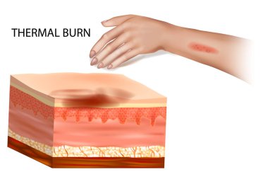 Cilt Haçı Bölümü Termal Yanığın Etkilerini Gösteriyor. Termal Yanık Yarasının Tıbbi İllüstrasyonu