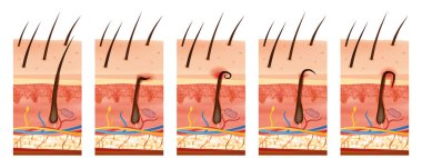 Eğitici tıbbi diyagram, insan derisinin çapraz kesiminde farklı türde kıllar gösteriyor. Resimlerde normal saç uzaması, derinin altında sıkışmış saçlar, derinin içine doğru kıvrılan kıvrımlar ve şişmiş saçlar görülüyor..