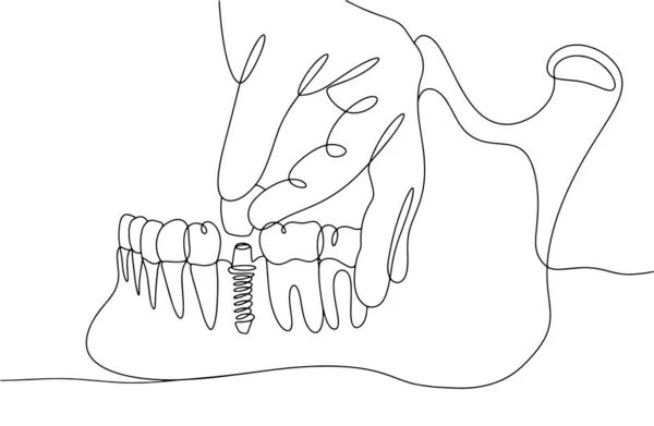 人の下顎に歯を移植する 歯科技工士の仕事 ヨーロッパ歯科技工士の日 異なる用途のための1つの線画 ベクターイラスト — ストックベクタ