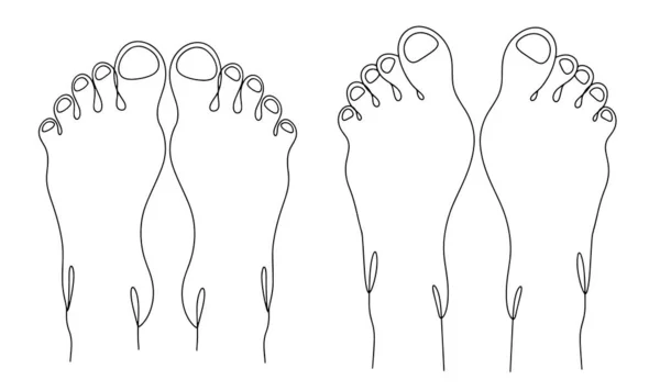 人类的腿从上面看正常的脚和假肢畸形 世界大脚日 不同用途的单行绘图 矢量说明 — 图库矢量图片