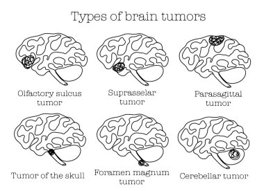 İnsan beyin tümörlerinin türleri. Farklı kullanım alanları için bir çizgi. Vektör illüstrasyonu.