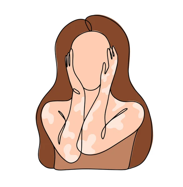 Een Vrouw Met Huidpigmentatie Stoornis Lichte Vlekken Huid Vitiligo Wereld — Stockvector