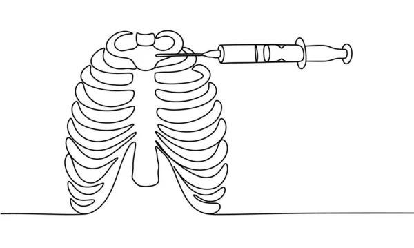 Τρύπημα Του Μυελού Των Οστών Στο Ανθρώπινο Στήθος Αιώνια Παρακέντηση — Διανυσματικό Αρχείο