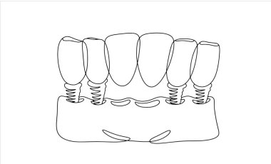 6 diş için diş köprüsü. Diş hekiminin estetik restorasyonu. Farklı kullanım alanları için bir çizgi. Vektör illüstrasyonu.