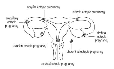 Types of ectopic pregnancy. Pregnancy when the egg is not implanted in the uterus. Line medical illustration with captions. clipart