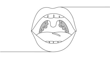 Bademcikleri soyutlanmış bir adamın ağzını aç. Gırtlak girişinin her iki tarafında da bulunan lenfoid doku koleksiyonu. Tıbbi bir tema üzerine siyah-beyaz çizimler.