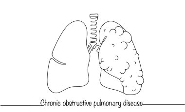 Bir sağlıklı akciğer ve ikincisi hastalık belirtileri. Kronik obstrüktif akciğer hastalığı. Farklı kullanımlar için basit çizgi illüstrasyonu.
