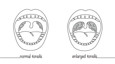Görünür bademcikleri olan açık bir ağız. Normal ve iltihaplı insan bademcikleri. Basit çizgi çizimi. Beyaz arkaplanda izole edilmiş vektör.