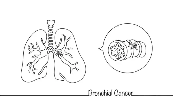 支气管受癌症影响的人类肺 一种肿瘤学疾病 由支气管腺体和上皮形成 覆盖呼吸道 带线条的医学说明 矢量图形