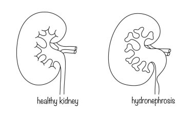 A healthy kidney and a kidney with hydronephrosis. Pathological expansion of the kidney-lobe system. Accumulation of excess fluid in the kidney. Vector illustration. clipart