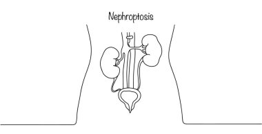 Böbreğin aşağı doğru kaydığı patolojik bir durum. Beyaz arkaplanda basit çizgi çizimi.