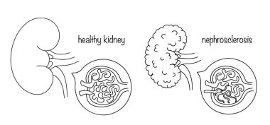 Sağlıklı bir böbrek ve nefrosklerozlu bir böbrek. Böbrek hasarı. Boyutunu küçültüp yerine lifli doku koymaktan oluşuyor. Farklı kullanımlar için tıbbi illüstrasyon.