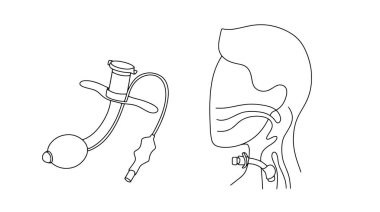 Trakeostomi ve trakeostomisi olan bir adam. Nefes borusunda nefes almayı kolaylaştıracak cerrahi bir açıklık yaratmak için bir ameliyat. Vektör illüstrasyonu
