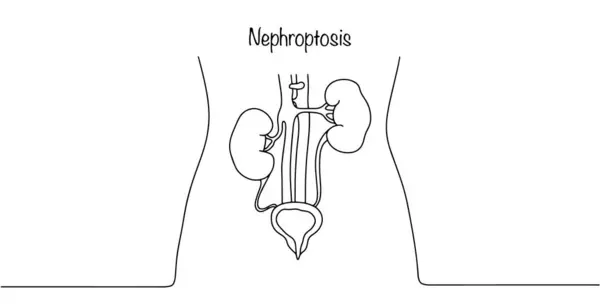 肾病一种肾脏向下移位的病理状况白色背景上的简单线条说明 图库插图