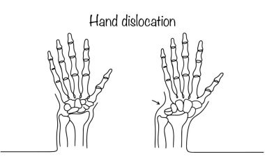 Sağlıklı bir insan eli ve bileğinde çıkık olan bir el. Eklem yüzeylerinin yerinden oynadığı anormal bir durum. Vektör illüstrasyonu.