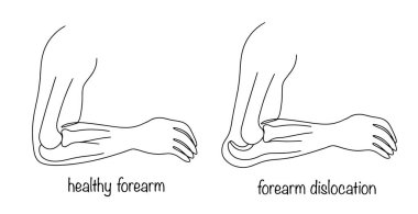 Sağlıklı bir kol ve ön kolu çıkmış bir kol. Kol kemiğinin, dirsek kemiğinin ve ön kol kemiğinin yüzeyleri yerinden oynamış. Tıbbi bir temada basit bir vektör.