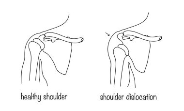 Healthy shoulder and dislocated shoulder. Prolapse of the head of the humerus from the glenoid cavity. Illustration on a medical theme.  clipart