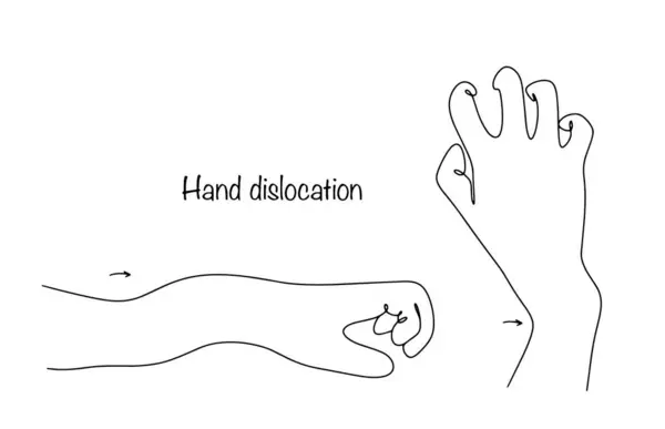 人类手腕的各种脱臼由于创伤性影响而导致关节移位 白色背景上的分离载体 矢量图形