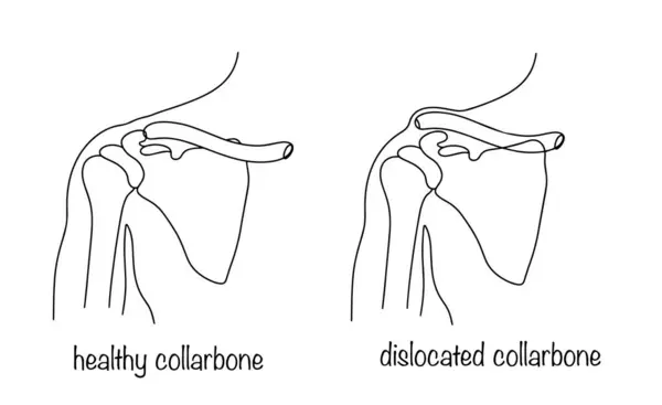 锁骨在体内的正确和不正确的位置 锁骨脱臼离骨在胸骨段的正常位置 医疗媒介说明 矢量图形