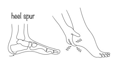 Heel spur. A bone growth that has the shape of a spike in the heel area. Pain in the leg due to the presence of a heel spur. Vector illustration. clipart