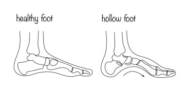Cavus ayak sendromu ayağın aşırı yüksek boylamlı kemeriyle karakterize edilir. Bacak ve bacağında deformasyon var. Tıbbi illüstrasyon. Beyaz arkaplanda izole edilmiş vektör.