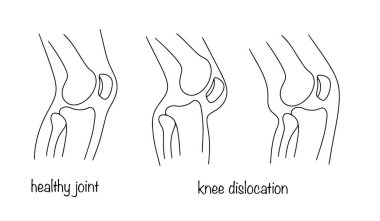 Healthy knee and knee dislocation. Displacement of the femur. Medical illustration. Human anatomy. clipart