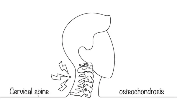 stock vector Silhouette of a man with osteochodrosis of the cervical spine. A disease of the musculoskeletal system that causes discomfort. Simple black and white illustration. 