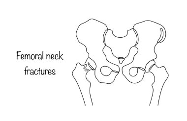 Femoral neck fracture. A dangerous injury in which the integrity of the section of the femur between the articular head and the greater trochanter is disrupted. clipart