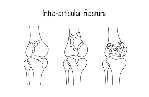 stock vector Different types of intra-articular fracture. A fracture in which the fracture line of the bone is located directly in the joint cavity. Medical vector illustration.