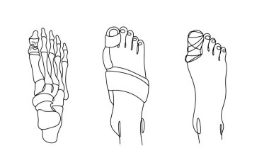 Baş parmağın kemiğindeki bütünlüğün bozulması. Ayak parmağı kırılmış. Kırığı alçıyla ya da ortozu ile tedavi ediyorum. Tıbbi bir tema üzerine vektör illüstrasyonu.